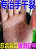 治手裂的药膏防干裂手脚上开裂脚后跟真菌感染防手指严重脱皮专用