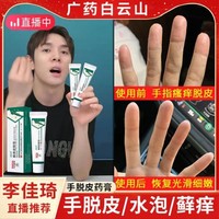 汗状疱疹专用软膏药膏，泡手藓真菌感染手气，膏蜕皮手指脱皮水泡烂手