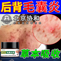 北京协和生物马拉色菌毛囊炎