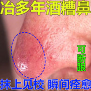 日本酒糟鼻草莓鼻修复鼻子鼻螨清治鼻头去黑头除螨虫祛粉刺专用药