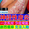 神经性皮炎外用膏顽固无激素皮肤病真菌感染湿疹止痒去顽固根BS