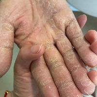 手脱皮修复霜季节性，手掌手指头蜕皮开裂干裂维生素褪起皮掉皮爆
