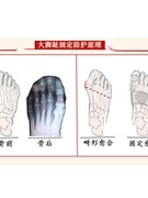 定制大脚拇指拇外翻矫正器甲沟脚趾套骨折固定器护具脚受伤打石膏