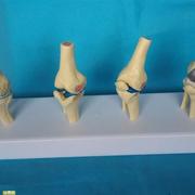 病变膝关节比较模型，骨骼骨架模型医用人体标本模型