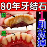 牙结石溶解牙石速效去除牙渍牙垢黄牙美白神器清除牙齿污垢专用膏