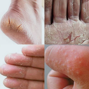 手掌手脚皮肤干燥脱皮手裂口，干裂修复霜治脚裂脚后跟，手指头开裂膏