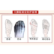 定制大脚拇指拇外翻矫正器甲沟脚趾套骨折固定器护具脚受伤打石膏
