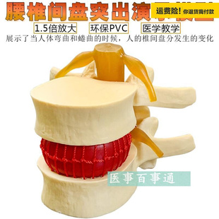 脊.柱模型脊椎骨头，腰椎间盘模具椎体模型，突出受压病理骨质教具包