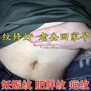 去妊娠纹肚c子妊辰纹产后消除大腿肥胖纹，k生长纹预防紧致产后修复