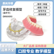 牙齿口腔模型教学种植修复金杆卡牙科仿真半口修复演示水洗可拆卸