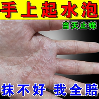 汗泡疱疹疱手痒脱皮汗孢疹汗状孢疹专用药膏，夏季手上起小水泡干裂