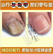 用疗效说明一切！灰指甲甲癣甲沟炎克星纯中药配方一次到位防复发