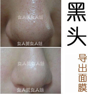 祛黑头面膜/去黑头导出液粉状 正品白头粉刺鼻贴 收毛孔产品鼻膜
