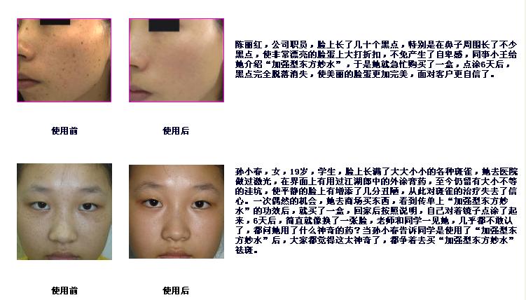 快速祛斑、遗传性雀斑、扁平疣加强型东方妙水